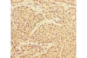 Immunohistochemistry of paraffin-embedded human ovarian cancer using ABIN7174174 at dilution of 1:100 (PRPF4 anticorps  (AA 1-260))