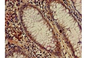 Immunohistochemistry of paraffin-embedded human colon cancer using ABIN7155043 at dilution of 1:100 (c-MET anticorps  (AA 83-209))