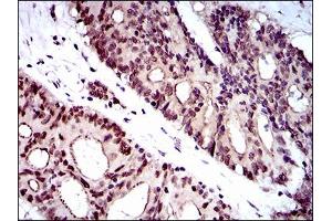 Immunohistochemical analysis of paraffin-embedded colon cancer tissues using WHSC2 mouse mAb with DAB staining.