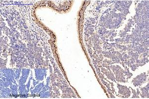 Immunohistochemical analysis of paraffin-embedded human lung cancer tissue. (Collagen Type I anticorps)
