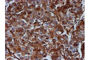 Immunohistochemical staining of paraffin-embedded Carcinoma of Human liver tissue using anti-TUBB4 mouse monoclonal antibody. (TUBB4 anticorps)