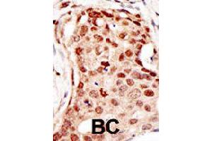 Formalin-fixed and paraffin-embedded human cancer tissue reacted with CBLC polyclonal antibody  , which was peroxidase-conjugated to the secondary antibody, followed by DAB staining. (CBLC anticorps  (C-Term))