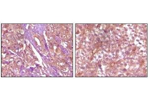 Immunohistochemical analysis of paraffin-embedded Human pancreas carcinoma (left) and breast carcinoma (right) tissue, showing membrane and cytoplasmic (pancreas carcinoma) localization, membrane (breast carcinoma) localization using EphB4 antibody with DAB staining. (EPH Receptor B4 anticorps)