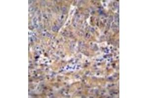 Formalin fixed and paraffin embedded human hepatocarcinoma reacted with DEF Antibody (N-term) followed by peroxidase conjugation of the secondary antibody and DAB staining (C11ORF58 anticorps  (N-Term))
