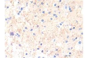 Detection of IL13 in Human Glioma Tissue using Polyclonal Antibody to Interleukin 13 (IL13)
