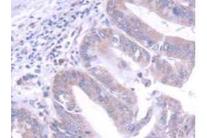 DAB staining on IHC-P; Samples: Human Liver cancer Tissue (FGF20 anticorps  (AA 1-211))