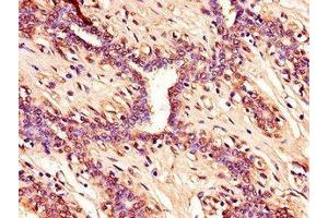 Immunohistochemistry of paraffin-embedded human breast cancer using  at dilution of 1:100 (CDKN2A anticorps  (AA 1-86))