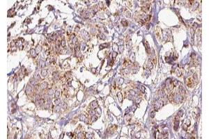 ABIN6275243 at 1/100 staining Human breast cancer tissue by IHC-P. (MRPL39 anticorps  (C-Term))