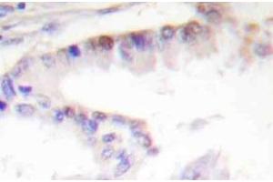 Immunohistochemistry (IHC) analyzes of CREB-1 antibody in paraffin-embedded human lung carcinoma tissue. (CREB1 anticorps)