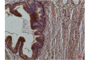 Immunohistochemistry (IHC) analysis of paraffin-embedded Human Colon Carcinoma using STAT3 Mouse Monoclonal Antibody diluted at 1:200. (STAT3 anticorps)