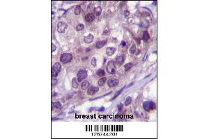 NR3C1 Antibody immunohistochemistry analysis in formalin fixed and paraffin embedded human breast carcinoma followed by peroxidase conjugation of the secondary antibody and DAB staining. (Glucocorticoid Receptor anticorps  (AA 236-262))
