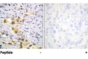 Immunohistochemical analysis of paraffin-embedded human lung carcinoma tissue using IGF2R polyclonal antibody . (IGF2R anticorps)