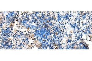 Immunohistochemistry of paraffin-embedded Human lung cancer tissue using NUDT10 Polyclonal Antibody at dilution of 1:70(x200)