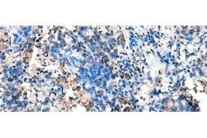 Immunohistochemistry of paraffin-embedded Human lung cancer tissue using NUDT10 Polyclonal Antibody at dilution of 1:70(x200) (NUDT10 anticorps)