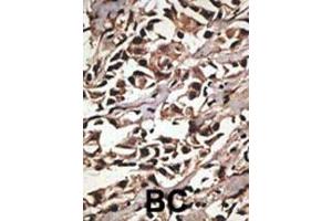 Formalin-fixed and paraffin-embedded human cancer tissue reacted with the primary antibody, which was peroxidase-conjugated to the secondary antibody, followed by DAB staining.