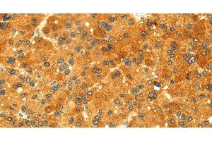 Immunohistochemistry of paraffin-embedded Human liver cancer tissue using GK1 Polyclonal Antibody at dilution 1:60 (Glycerol Kinase anticorps)