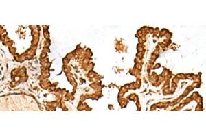 Immunohistochemistry of paraffin-embedded Human thyroid cancer tissue using FAM200A Polyclonal Antibody at dilution of 1:55(x200) (FAM200A anticorps)