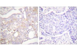 Peptide - +Immunohistochemical analysis of paraffin-embedded human breast carcinoma tissue using Claudin 4 antibody (#C0141). (Claudin 4 anticorps)