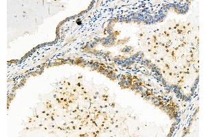 ABIN6257891 and ABIN6273815 at 1/100 staining Human prostate cancer by IHC-P. (TRIO anticorps  (Internal Region))