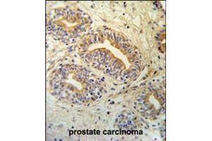 CWC15 Antibody IHC analysis in formalin fixed and paraffin embedded prostate carcinoma followed by peroxidase conjugation of the secondary antibody and DAB staining.