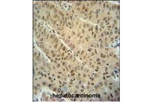 WDR32 antibody (N-term) (ABIN654593 and ABIN2844292) immunohistochemistry analysis in formalin fixed and paraffin embedded human hepatocarcinoma followed by peroxidase conjugation of the secondary antibody and DAB staining. (DCAF10 anticorps  (N-Term))