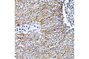 Immunohistochemistry of paraffin-embedded human lung cancer using β-Catenin antibody (ABIN7266137) at dilution of 1:100 (40x lens).