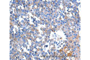 Immunohistochemistry of Human colon cancer using HINT2 Polyclonal Antibody at dilution of 1:60 (HINT2 anticorps)