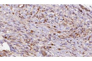 ABIN6272697 at 1/100 staining Human liver cancer tissue by IHC-P. (GRM2 anticorps  (Internal Region))