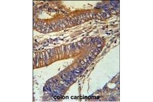 KLC3 Antibody (Center) (ABIN651542 and ABIN2840291) immunohistochemistry analysis in formalin fixed and paraffin embedded human colon carcinoma followed by peroxidase conjugation of the secondary antibody and DAB staining. (KLC3 anticorps  (AA 245-274))