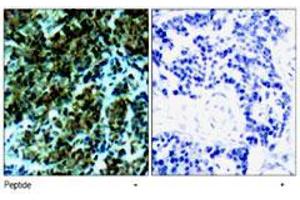 Immunohistochemical analysis of paraffin-embedded human breast carcinoma tissue, using Ctdp1 polyclonal antibody . (CTDP1 anticorps  (N-Term))