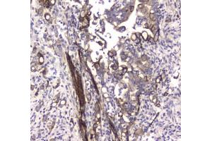 IHC testing of FFPE human colon cancer tissue with LC3A antibody at 1ug/ml. (MAP1LC3A anticorps)