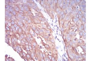 Immunohistochemical analysis of paraffin-embedded ovarian cancer tissues using TUBB1 mouse mAb with DAB staining.