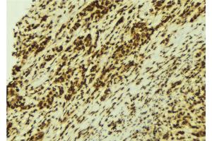 ABIN6274154 at 1/100 staining Human breast cancer tissue by IHC-P. (HNRNPC anticorps  (C-Term))
