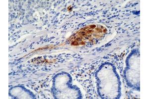 Immunohistochemistry staining of colon carcinoma (paraffin-embedded sections) with anti-p21 (WA-1). (p21 anticorps)
