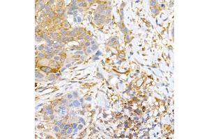 Immunohistochemistry of paraffin-embedded human esophageal cancer using CLIC4 Rabbit pAb (ABIN6127638, ABIN6138723, ABIN6138724 and ABIN6222890) at dilution of 1:50 (40x lens). (CLIC4 anticorps  (AA 1-253))