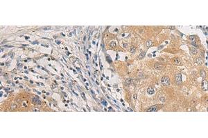 Immunohistochemistry of paraffin-embedded Human breast cancer tissue using AGAP3 Polyclonal Antibody at dilution of 1:25(x200) (AGAP3 anticorps)