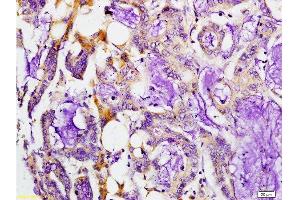 Formalin-fixed and paraffin embedded human colon carcinoma labeled with Rabbit Anti-MMP-7 Polyclonal Antibody, Unconjugated at 1:200 followed by conjugation to the secondary antibody and DAB staining.