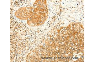 Immunohistochemistry of Human colon cancer using RARRES1 Polyclonal Antibody at dilution of 1:60 (RARRES1 anticorps)