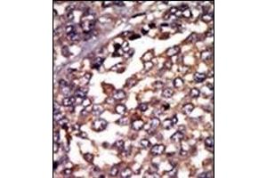 Formalin-fixed and paraffin-embedded human cancer tissue reacted with the primary antibody, which was peroxidase-conjugated to the secondary antibody, followed by AEC staining.
