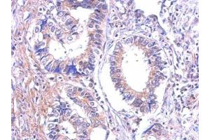 IHC-P Image Immunohistochemical analysis of paraffin-embedded human gastric cancer, using P2Y7, antibody at 1:500 dilution.