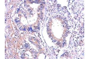 IHC-P Image Immunohistochemical analysis of paraffin-embedded human gastric cancer, using P2Y7, antibody at 1:500 dilution.