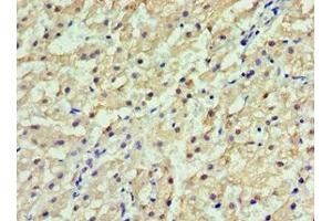Immunohistochemistry of paraffin-embedded human liver cancer using ABIN7154092 at dilution of 1:100