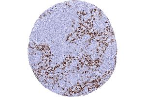 Strong factor XIII immunostaining of sinus histiocytes in a lymph node