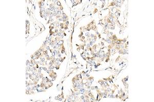 Immunohistochemistry of paraffin-embedded human breast cancer using /AMID Rabbit pAb (ABIN6129888, ABIN6136678, ABIN6136679 and ABIN6215707) at dilution of 1:25 (40x lens).