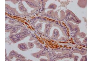 IHC image of ABIN7127855 diluted at 1:100 and staining in paraffin-embedded human prostate cancer performed on a Leica BondTM system.