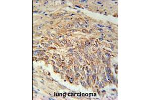 EBPL Antibody immunohistochemistry analysis in formalin fixed and paraffin embedded human lung carcinoma followed by peroxidase conjugation of the secondary antibody and DAB staining. (EBPL anticorps  (C-Term))