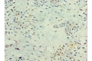 Immunohistochemistry of paraffin-embedded human breast cancer using ABIN7156607 at dilution of 1:100 (IL29 anticorps  (AA 20-200))