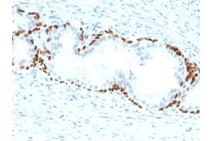 Formalin-fixed, paraffin-embedded human Prostate Carcinoma stained with p63 Mouse Monoclonal Antibody (TP63/2428).