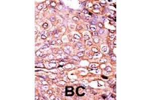 Formalin-fixed and paraffin-embedded human cancer tissue reacted with EP300 (phospho S89) polyclonal antibody  which was peroxidase-conjugated to the secondary antibody followed by AEC staining. (p300 anticorps  (pSer89))