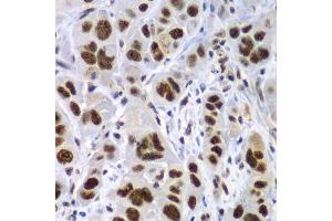 Immunohistochemistry of paraffin-embedded human gastric cancer using SF3B2 antibody.